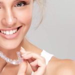 clear aligners