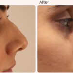 rhinoplasty surgery in Delhi