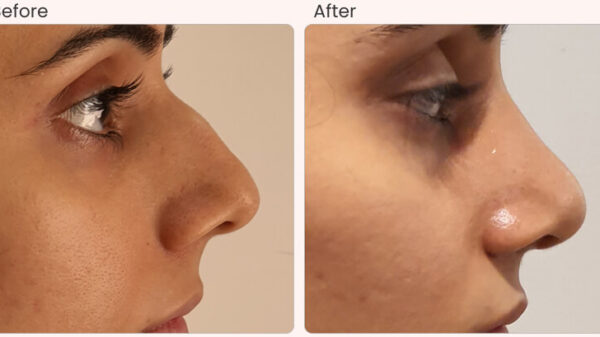 rhinoplasty surgery in Delhi