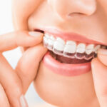 Braces vs. Invisalign in Salt Lake City: Which Option Is Right for You?