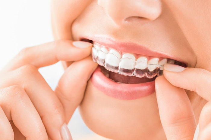 Braces vs. Invisalign in Salt Lake City: Which Option Is Right for You?