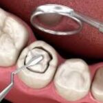 Dental Filling Materials